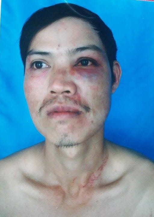nhap vien sau khi roi cong an phuong do “tu dap dau xuong ban”? hinh anh 2