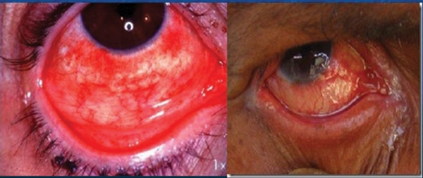 Nhiễm chlamydia trachomatis sinh dục - tiết niệu và những hệ lụy