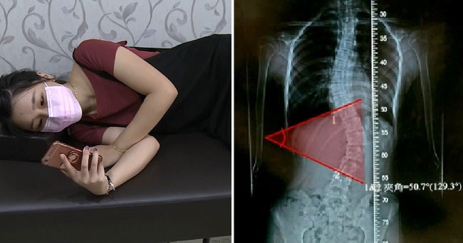 Giật mình với hình ảnh bàn tay bị liệt và cột sống cong: Bài học cho những ai hay dùng điện thoại theo cách này