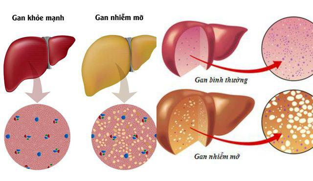 Không ăn chất béo, cô gái 23 tuổi vẫn bị gan nhiễm mỡ bởi lý do không ai ngờ tới