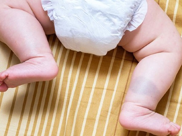 Trẻ bị chàm xanh: Những điều cha mẹ cần biết Trẻ bị chàm xanh: Những điều cha mẹ cần biết