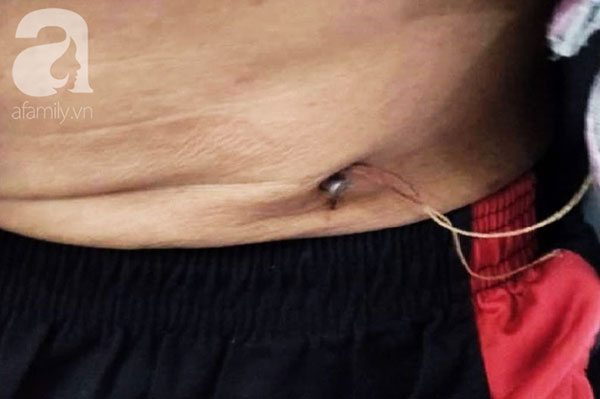 Tai nạn rợn người: Vấp té, người đàn ông bị đinh nhọn đâm từ rốn xuyên vào bụng