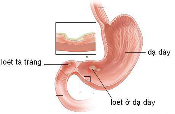5 kiểu người này tuyệt đối không nên ăn gừng