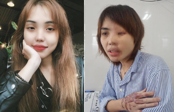 Axit tàn phá cơ thể khủng khiếp như thế nào?