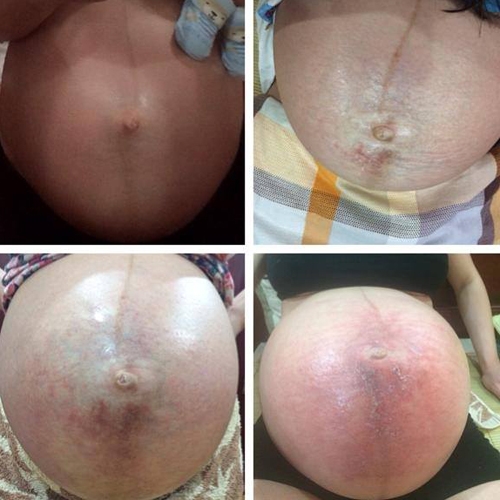 Mẹ bầu tuyệt vọng với bụng bầu mưng mủ