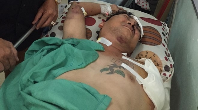 Ca si Viet bi tai nan mat mot canh tay dang hoi phuc hinh anh 1