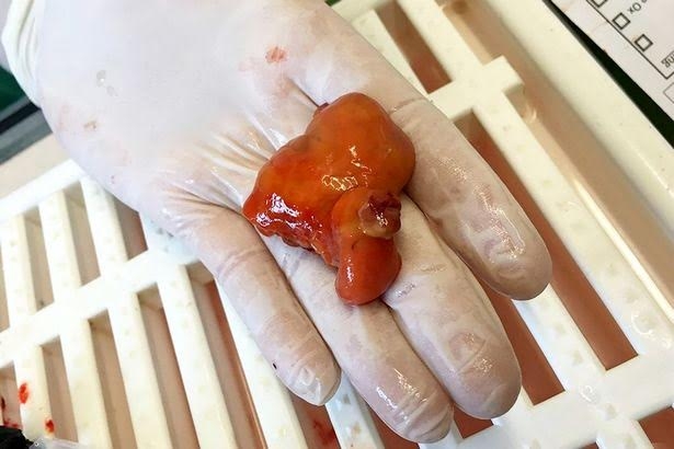  Khối u siêu lớn của Nemo. 