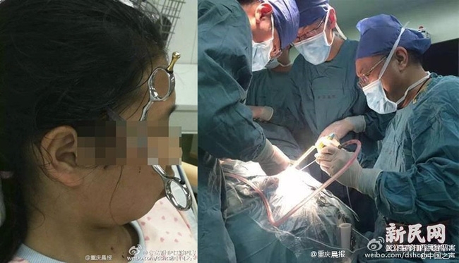 Bắt con làm bài tập không được, cha lỡ tay phi kéo cắm vào đầu con gái - Ảnh 1.