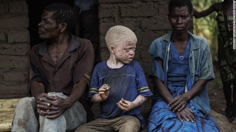 nan san nguoi bach tang lay xuong man ro o malawi hinh anh 1