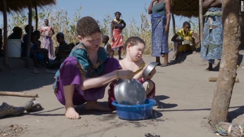 nan san nguoi bach tang lay xuong man ro o malawi hinh anh 2