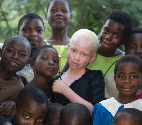 nan san nguoi bach tang lay xuong man ro o malawi hinh anh 3
