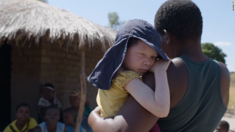 nan san nguoi bach tang lay xuong man ro o malawi hinh anh 4