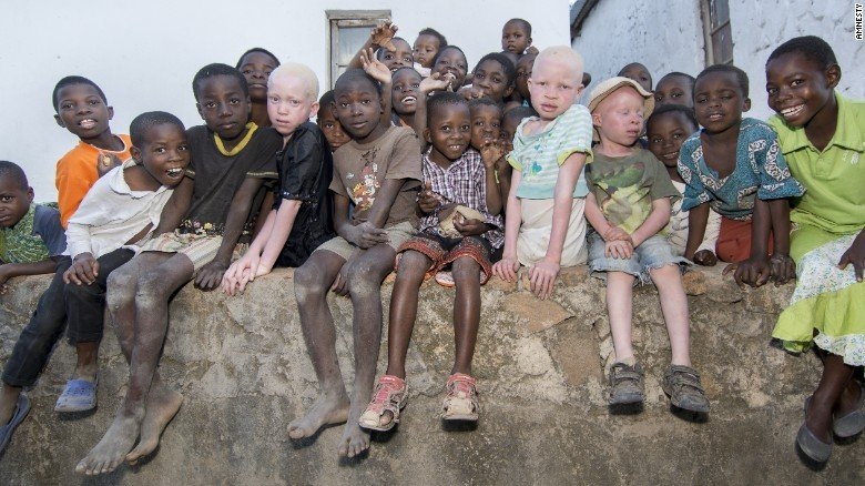 nan san nguoi bach tang lay xuong man ro o malawi hinh anh 5