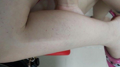 canh bao can benh nguy hiem thuong nham voi sot phat ban o tre - 1