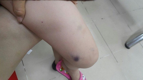 canh bao can benh nguy hiem thuong nham voi sot phat ban o tre - 2