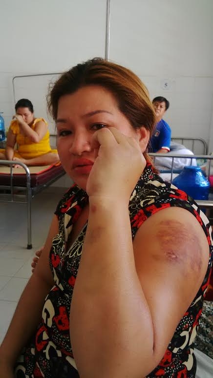  Chị Thùy Dương bị đánh bầm tay 