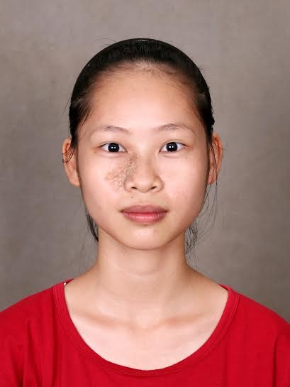 Xoá bỏ vết chàm trên mặt, nữ sinh này đã lột xác trở thành một con người hoàn toàn khác - Ảnh 2.