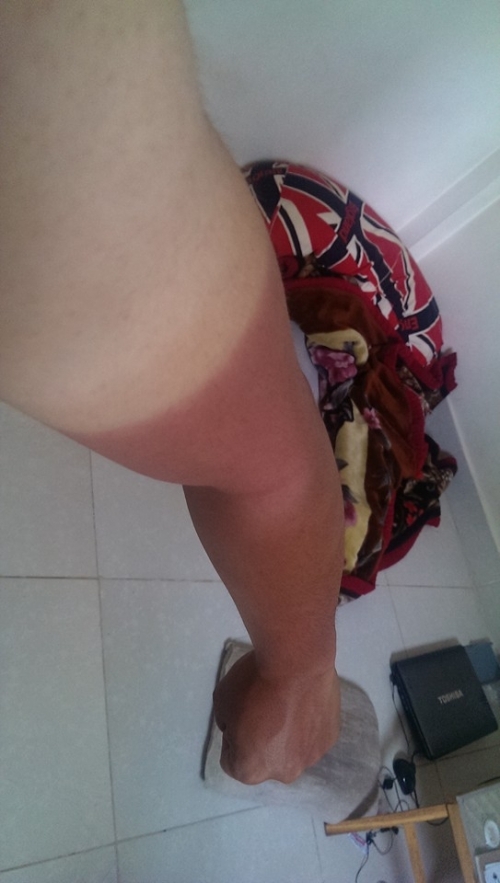 Bi hài những làn da ‘đổi màu’ vì nắng nóng - Ảnh 4