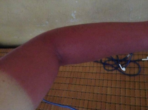 Bi hài những làn da ‘đổi màu’ vì nắng nóng - Ảnh 7