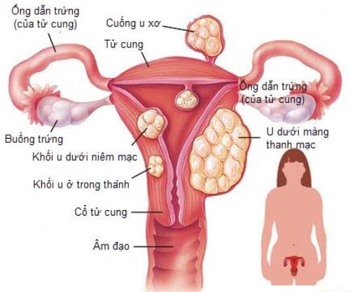 Các vị trí của u xơ tử cung
