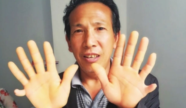 TQ: Bị đau, phát hiện trong bụng có 4 quả thận - 2