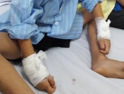vu mo tay trai rut dinh tay phai: bac si mo 5 ca/ngay rat de nham hinh anh 1