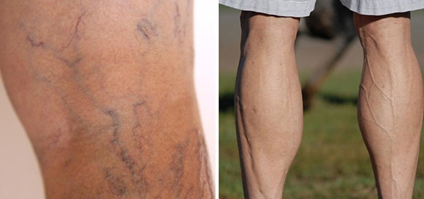 giãn tĩnh mạch chân, chân nổi mạch máu, chân nổi gan