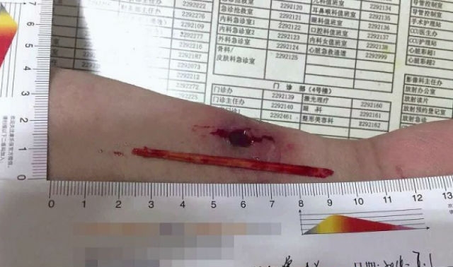 TQ: Thấy tay sưng, đi khám mới biết có đũa nằm bên trong - 1