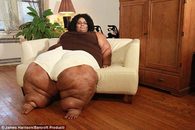  Katia Page, 36 tuổi, mắc bệnh Lipoedema khiến 2 chân to quá khổ 