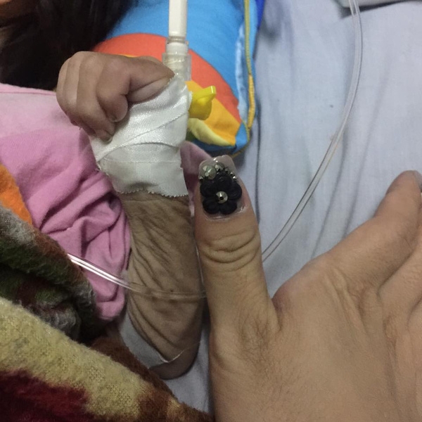Hành trình kỳ diệu thay da đổi thịt của bé gái 14 tháng tuổi chỉ nặng 3,5kg