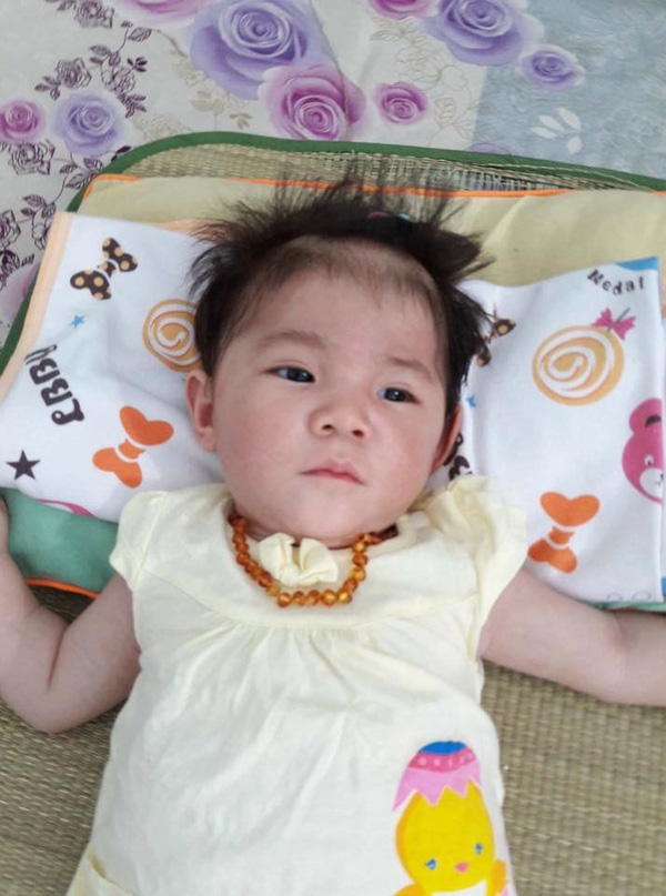 Hành trình kỳ diệu thay da đổi thịt của bé gái 14 tháng tuổi chỉ nặng 3,5kg
