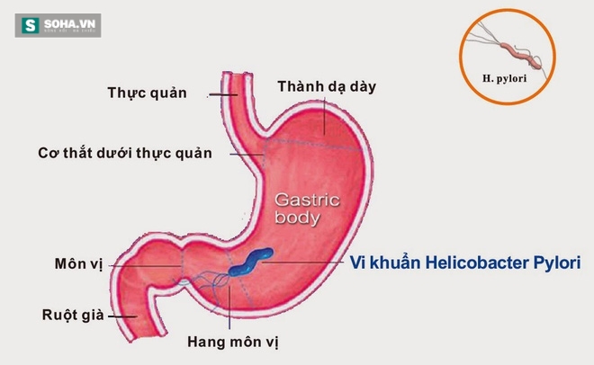 Bài thuốc chữa dạ dày khiến bệnh nhân mừng như bắt được vàng - Ảnh 2.