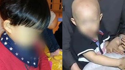 Từ một cậu bé có mái tóc đen dày, giờ bé Chang đã thành trọc đầu chỉ sau 1 tuần uống thảo dược.
