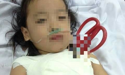 Be gai 5 tuoi bi keo cat dam xuyen nguc hinh anh 1