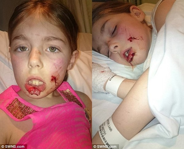 Cô bé Leah Carter với vết thương do chó cắn /// Ảnh: Daily Mail