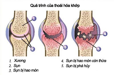 Thay khop goi nhan tao bang xi mang cho benh nhan thoai hoa hinh anh 1