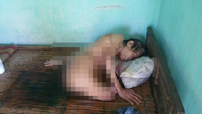 Cộng đồng kêu gọi giúp đỡ cụ bà mù, cụt chân đang thoi thóp vì vết thương lở loét - Ảnh 2.