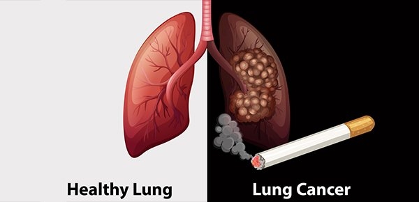ung thư phổi, cách chữa ung thư phổi, dấu hiệu ung thư phổi, triệu chứng ung thư phổi, cách chữa ung thư phổi tốt nhất
