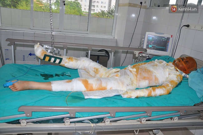 Bố của cô gái xinh đẹp bị bỏng nặng: “Con tôi bảo nó sợ cụt hết tay, thành dị dạng không ai dám đến gần” - Ảnh 2.