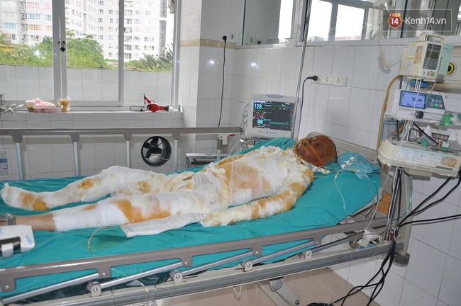 Bố của cô gái xinh đẹp bị bỏng nặng: “Con tôi bảo nó sợ cụt hết tay, thành dị dạng không ai dám đến gần” - Ảnh 8.
