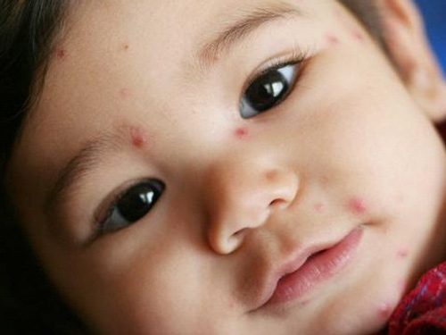 cach phong tranh 10 can benh pho bien o tre nho vao mua thu - 10