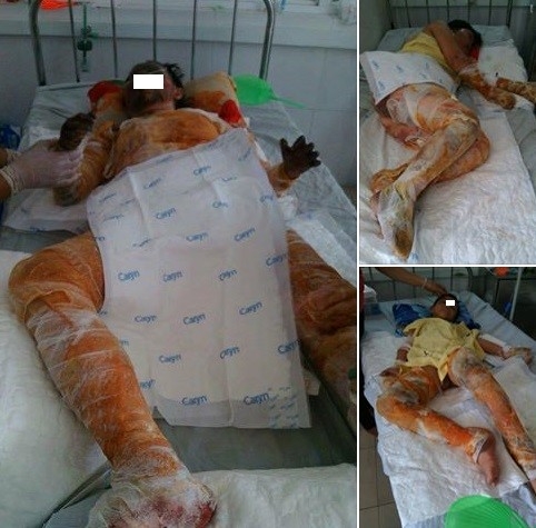 Cha hien da ghep cho con gai bi bong nang hinh anh 2