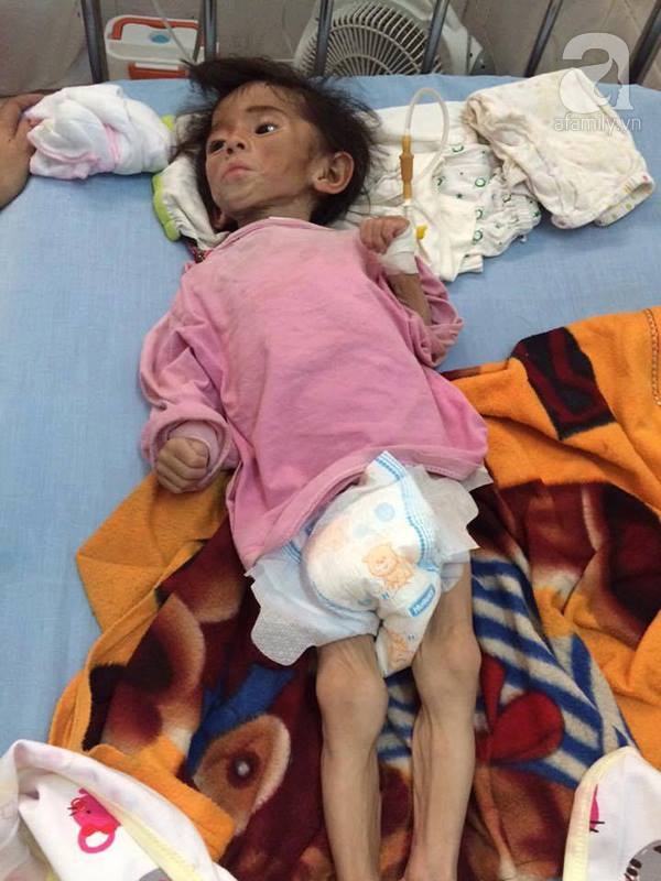 Sau hơn 3 tháng được mẹ nuôi chăm sóc, bé gái 14 tháng tuổi nặng 3,5kg giờ ra sao?