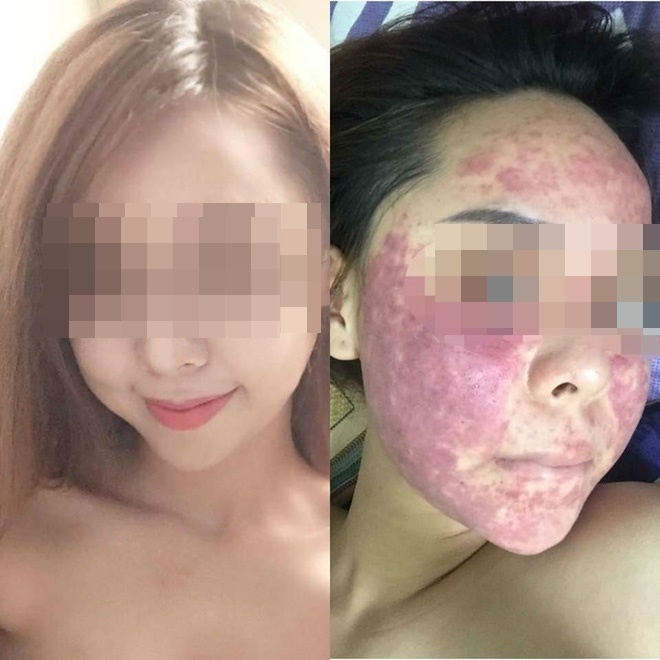 Cô gái chịu hậu quả nặng nề sau khi dùng kem thảo dược - Ảnh 1.