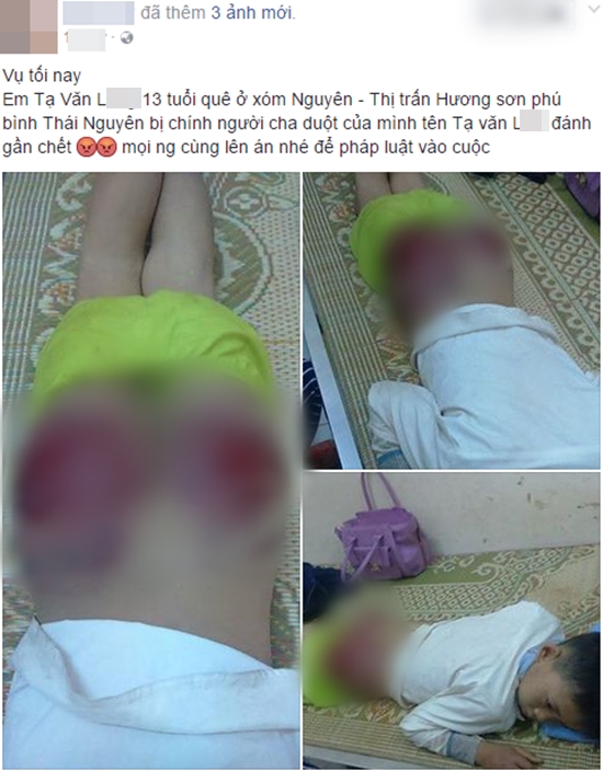 Hình ảnh gây phẫn nộ: Bé trai 13 tuổi bị cha ruột đánh tứa máu - Ảnh 1.
