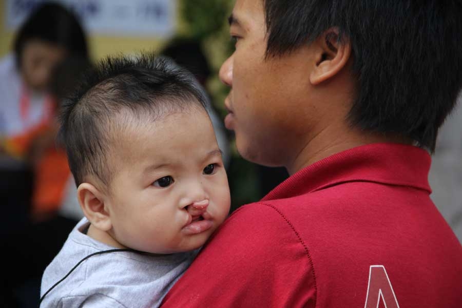phẫu thuật, nụ cười, sứt môi hở hàm ếch, trẻ em
