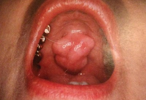 Một trường hợp u lồi khẩu cái cứng. Ảnh: denturaid.
