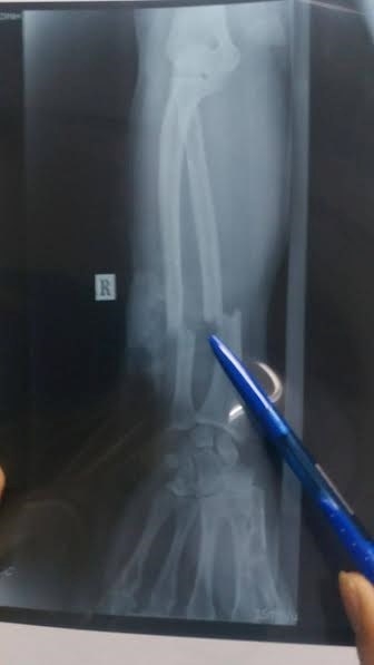 Nối thành công cánh tay người đàn ông bị chém đứt lìa ảnh 1