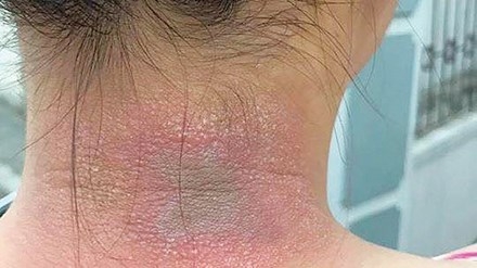 Tổn thương do bị kiến ba khoang tấn công.