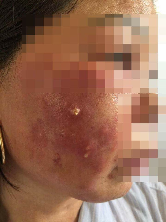  Ảnh mặt bệnh nhân bị nhiễm trùng vùng mặt. 